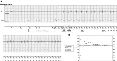 Case report: Short-long-short mechanism triggering sustained ventricular tachycardia in a patient with a single-chamber ICD but inhibiting antitachycardia therapy